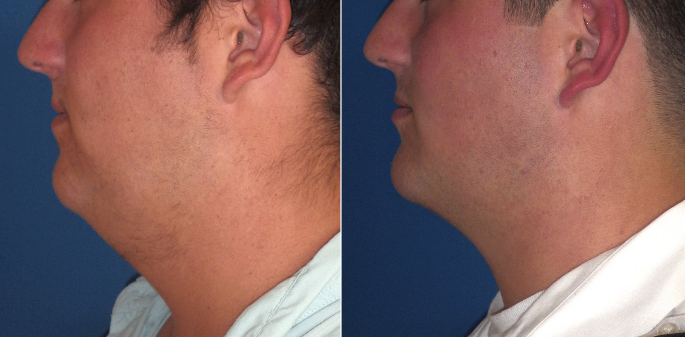 What is a Submentoplasty?