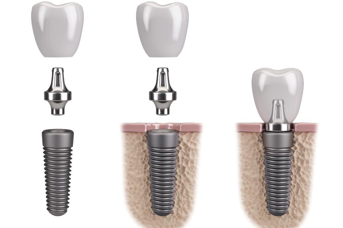 How Do Dental Implants Work Dental Implants Gulfgate, TX