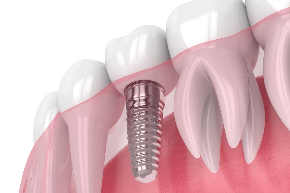 How Do Dental Implants Work? Dental Implants in Pasadena, Texas