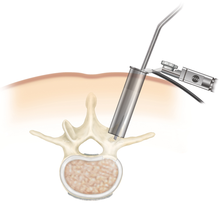 minimally invasive, minimally invasive surgery, spine surgery, wiltse