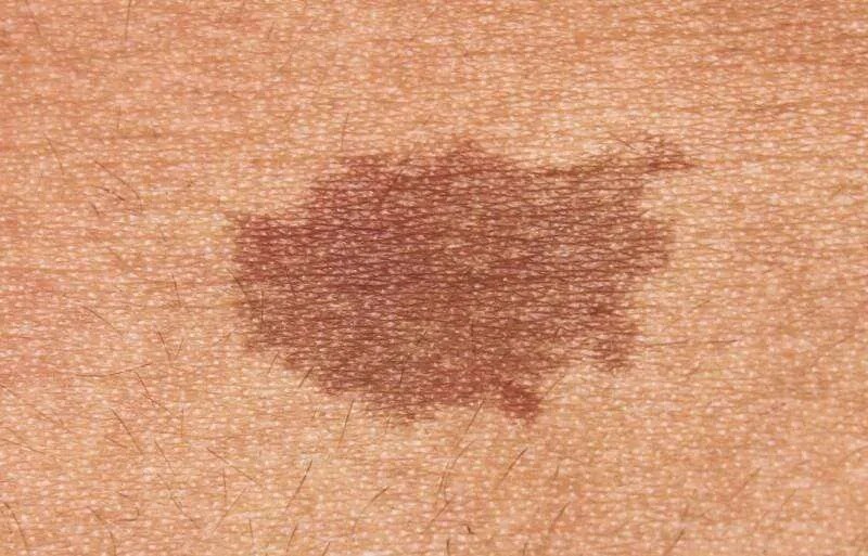 Birthmarks Removal Singapore LS Aesthetic Clinic