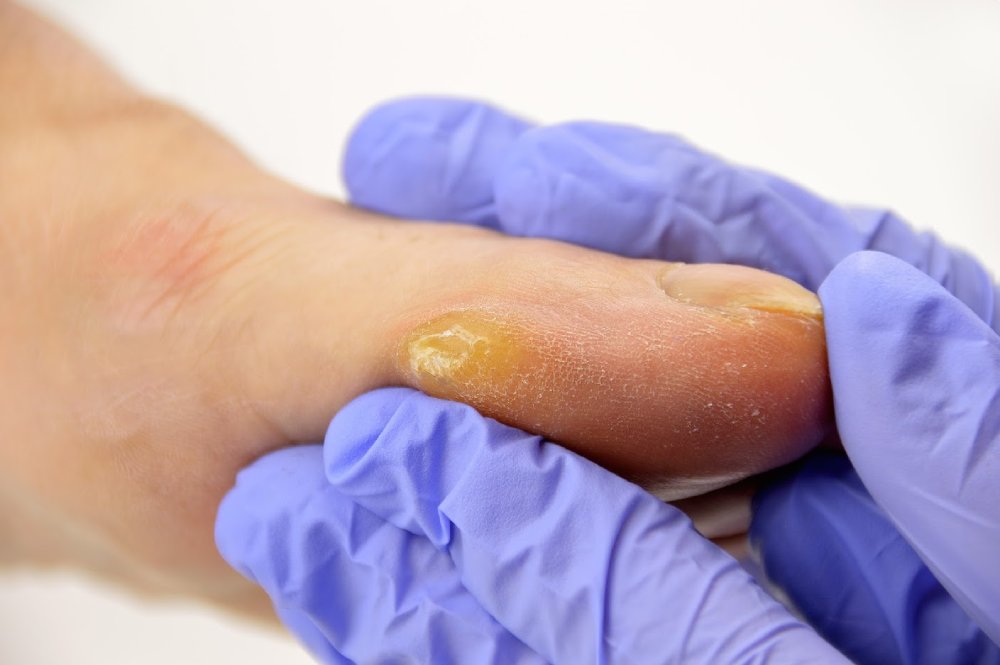 Corn Removal Surgery Miami Luxe Foot Surgery