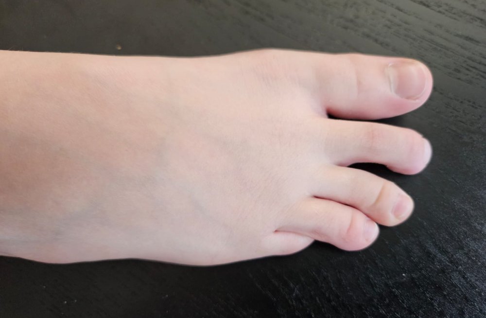 Pinky Toe Underlapping Causes, Effects, and Treatment Options