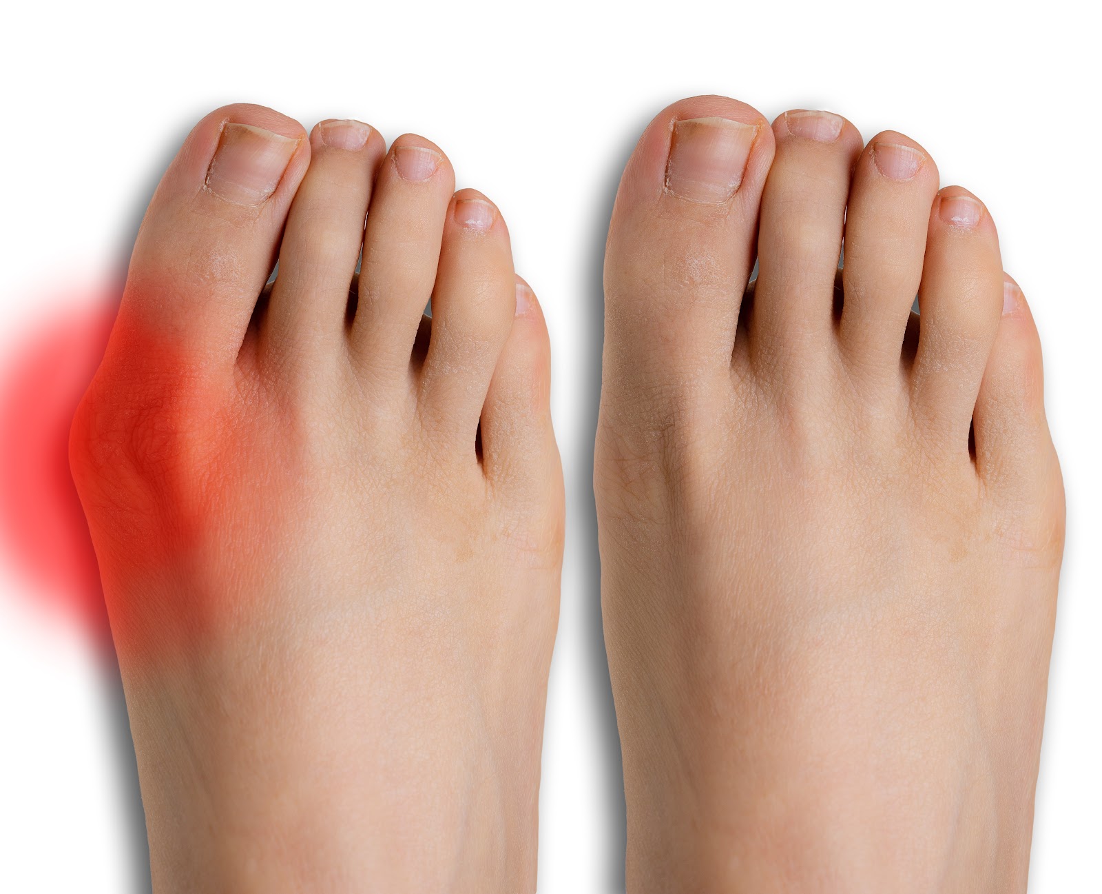 Understanding the Difference Normal Foot vs. A Bunion Luxe Foot Surgery