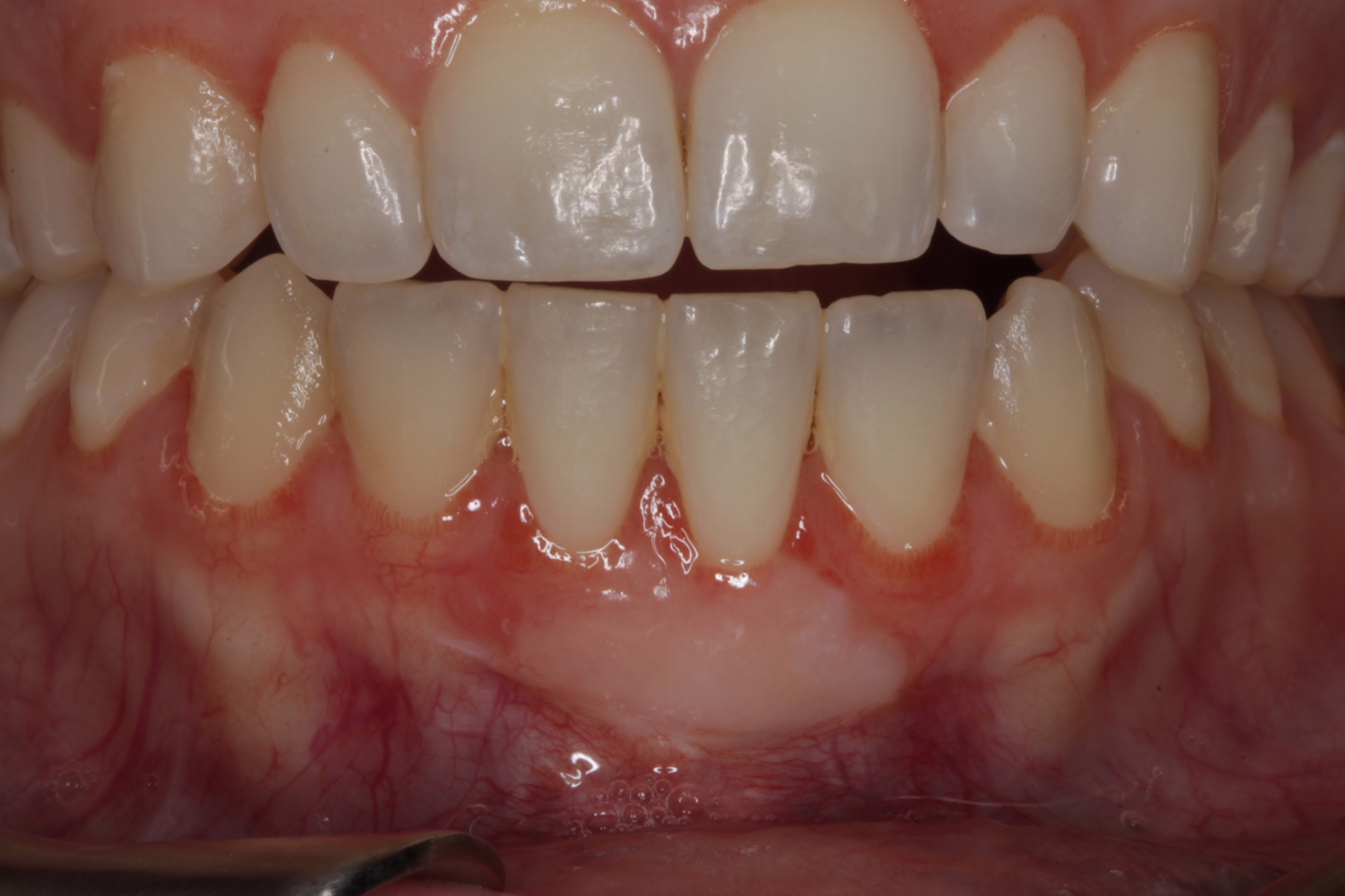 Soft Tissue Grafting Periodontist in Las Vegas Henderson