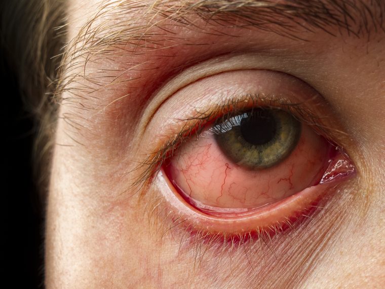 In some cases, pink eye might be an early symptom of COVID19