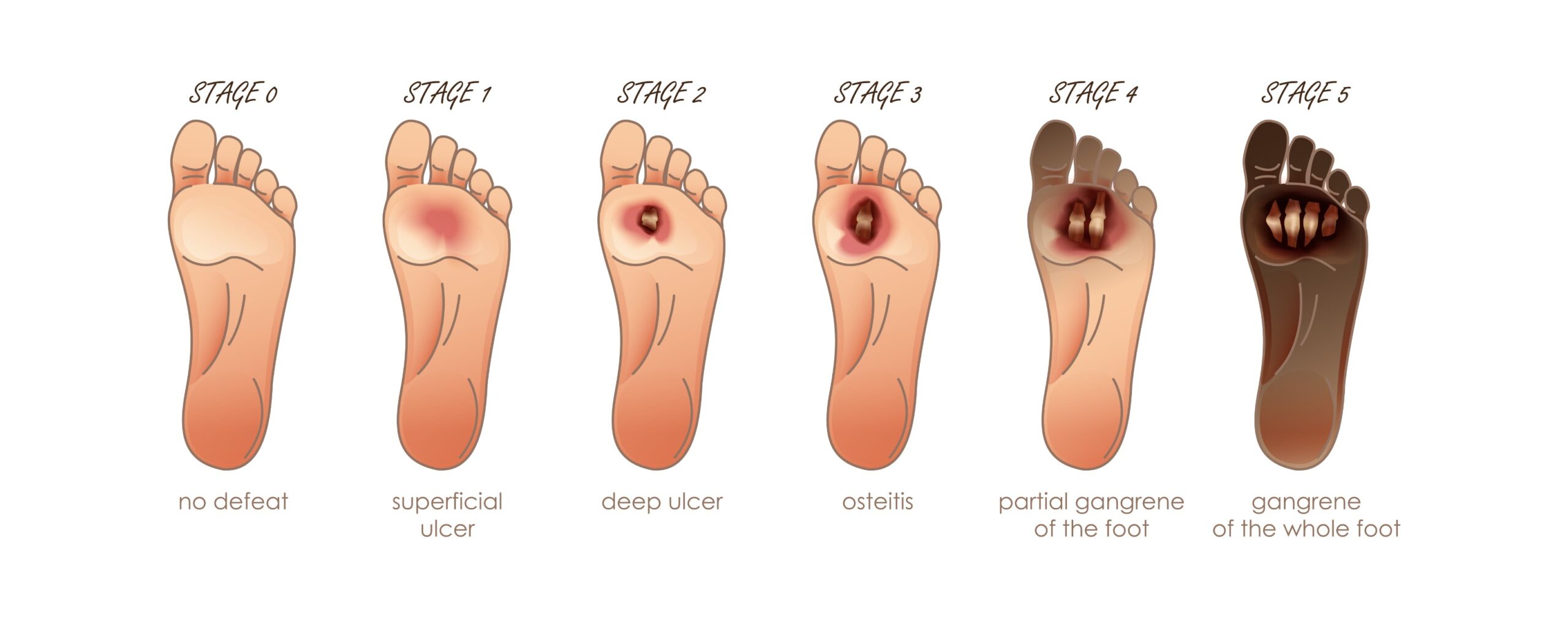 Foot Care In Diabetes Ppt at Teresa Mojica blog