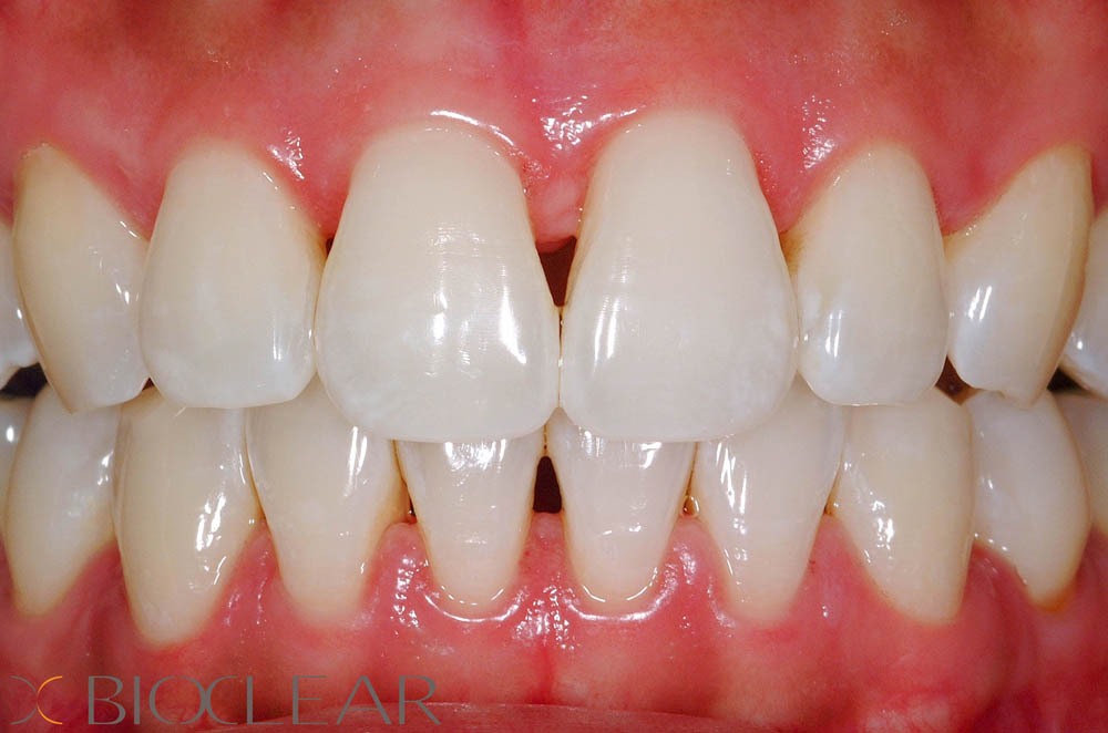 Black Triangles / Diastemas Lynbrook Smiles