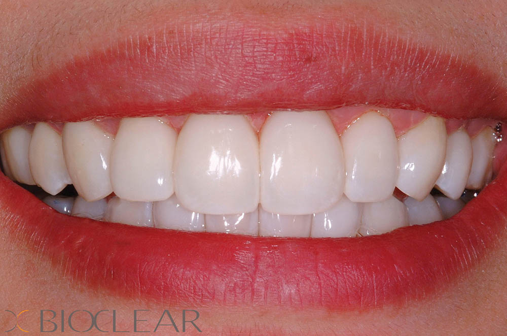 Black Triangles / Diastemas Lynbrook Smiles