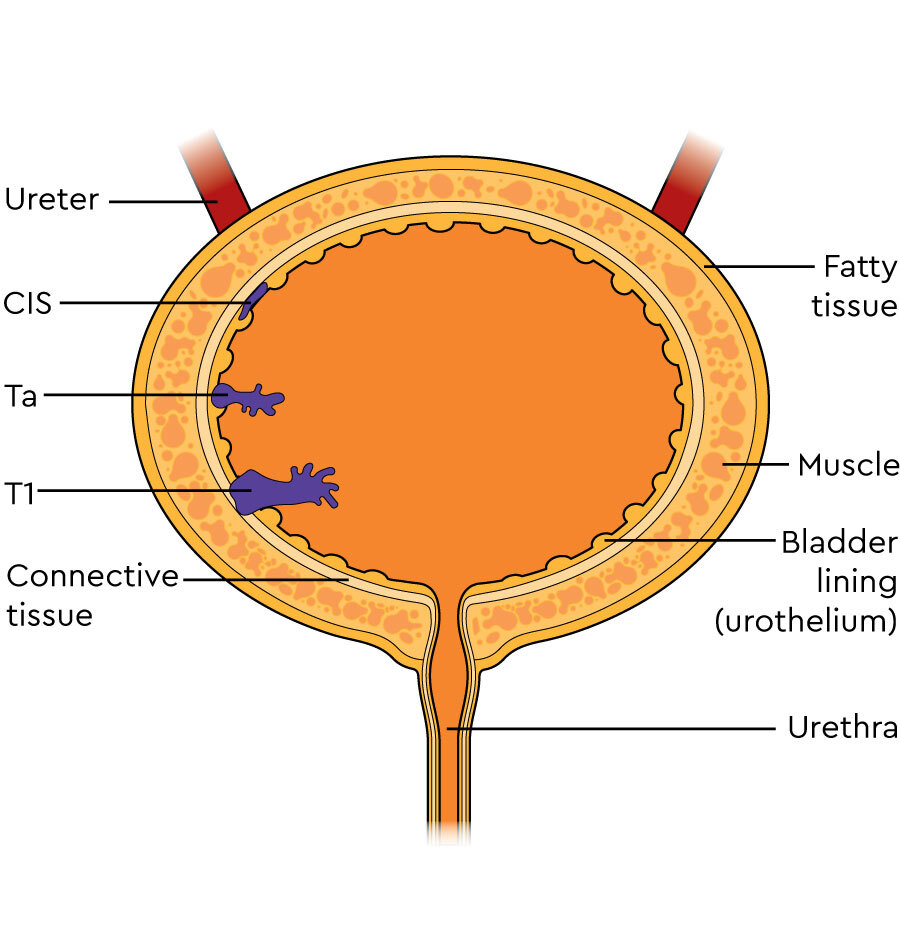Non Invasive Bladder Cancer Symptoms