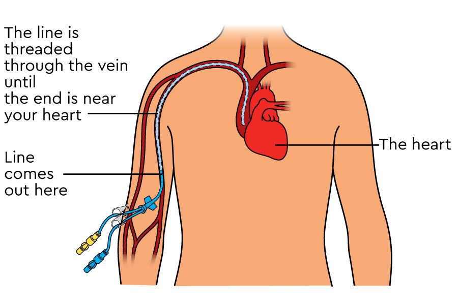 Picc Catheter