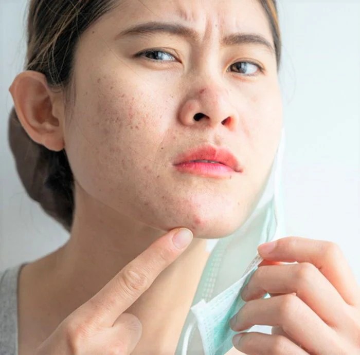 Best Skincare Products To Treat Maskne Macqueza