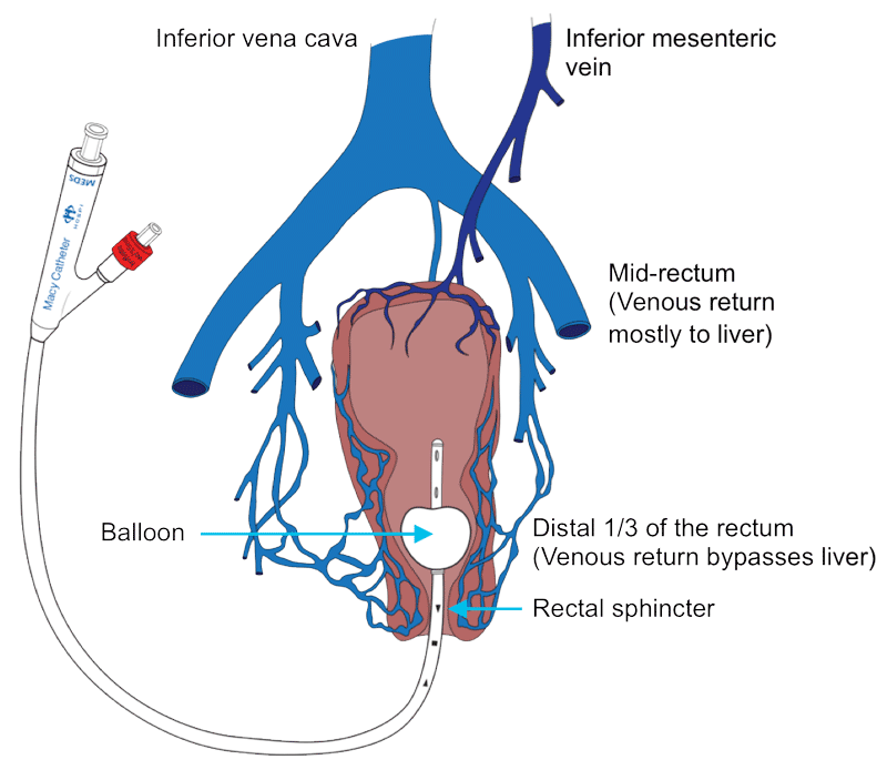 Skilled Nursing Facility The Macy Catheter