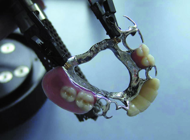 madent Zahntechnik Leistungen Kombinierte Prothesen