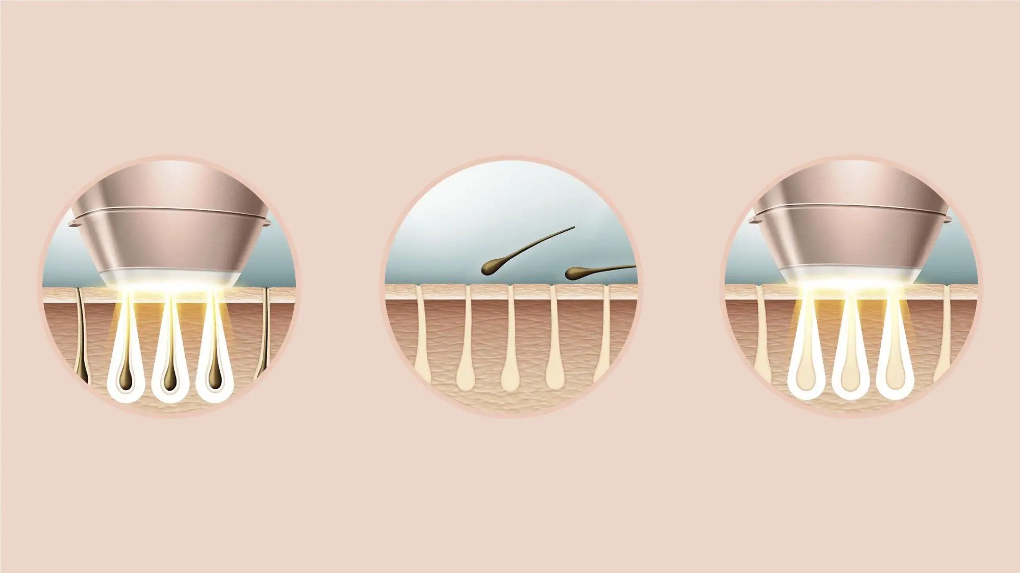 Philips Lumea IPL BRI958/00 Serija 9000 uređaj za uklanjanje dlaka