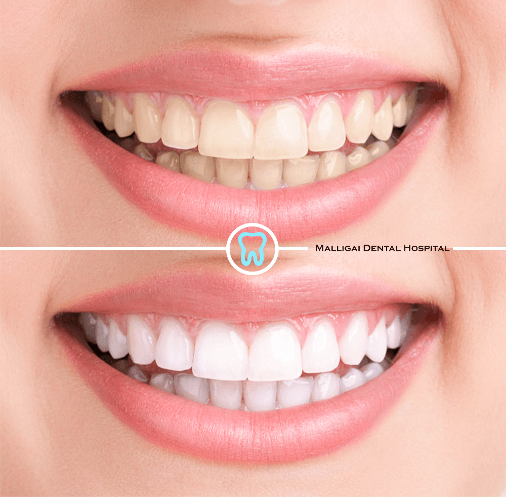 Buch alltäglich Dual laser teeth whitening cost in india Eisig Duft