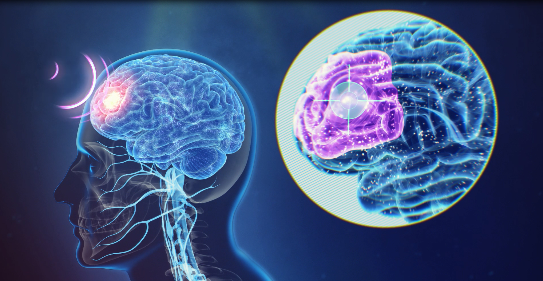 Transcranial Stimulation (TMS) Therapy Medical Associates of