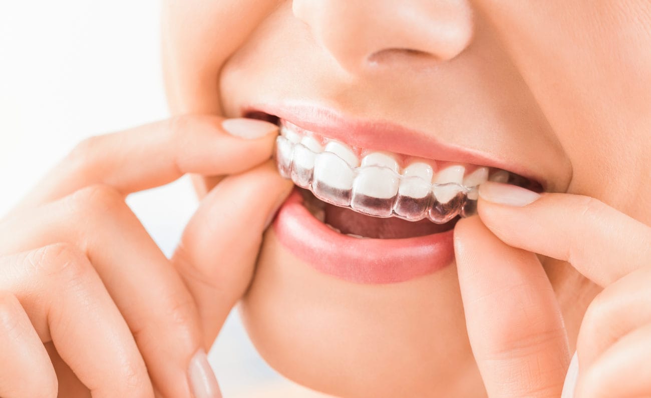 Straightening Crooked Teeth Without Braces Manassas Smiles