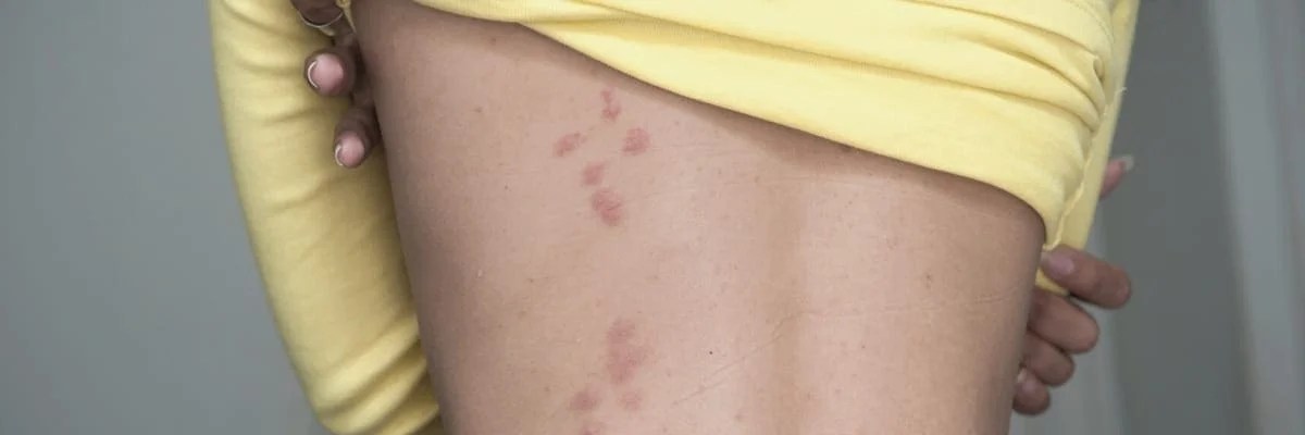 How Do I Know if I Have Bed Bugs? 7 Signs of Bed Bugs