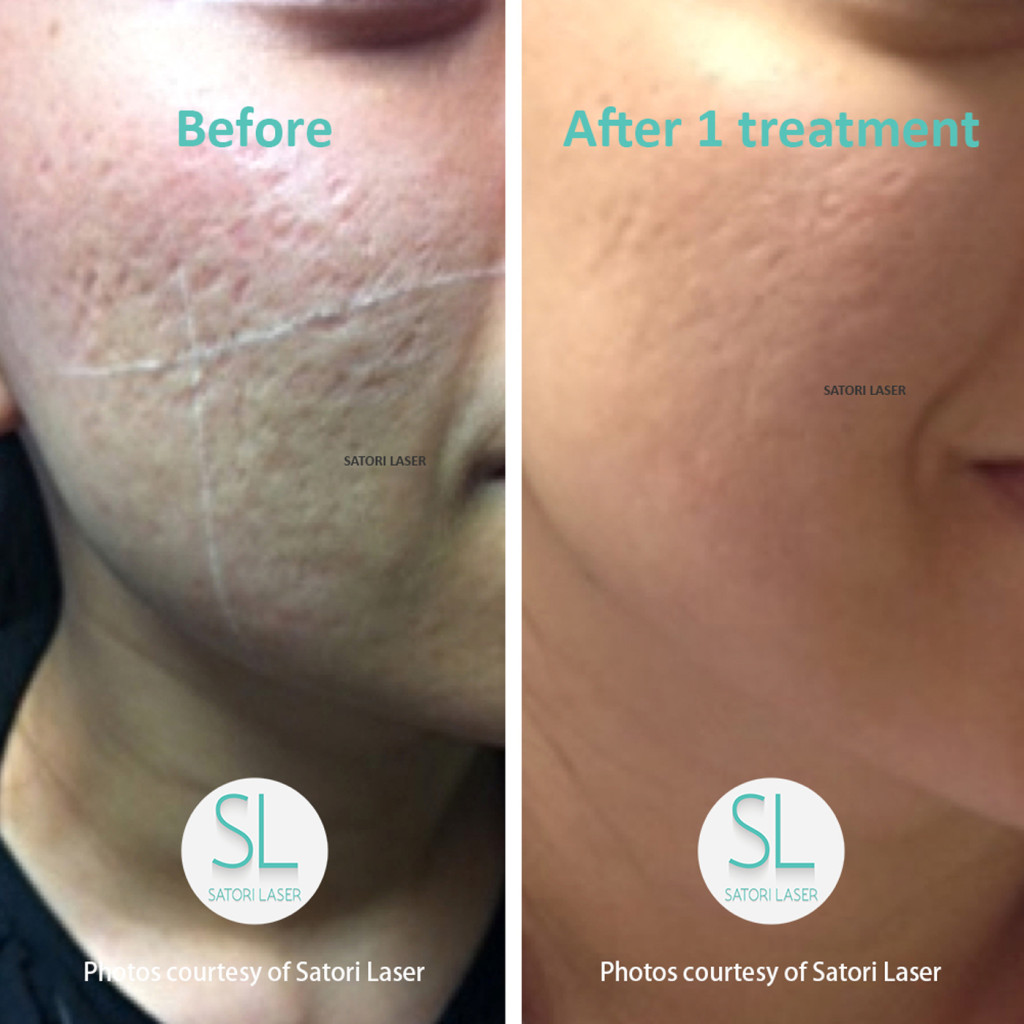 Satori Laser Hair Removal & Skin Rejuvenation NYNJCTPA