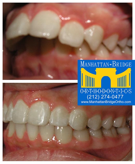 Before and After Overjet Manhattan Bridge Orthodontics