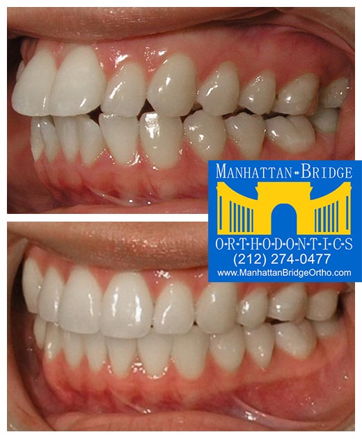 Before and After Overjet Manhattan Bridge Orthodontics