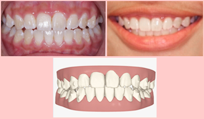 The Size and Shape of Your Teeth - Manhattan Bridge Orthodontics