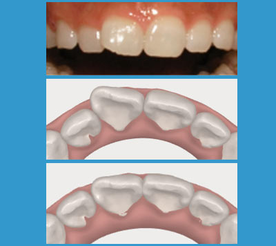 The Size and Shape of your Teeth | Manhattan Bridge Orthodontics