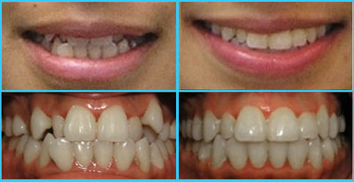 The Size and Shape of Your Teeth - Manhattan Bridge Orthodontics