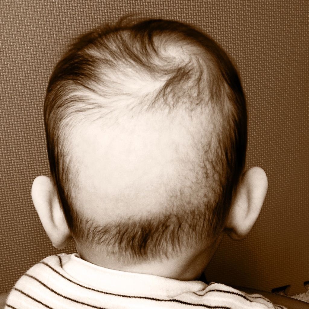 Top 32+ Wallpapers bald spot on back of head female Sharp