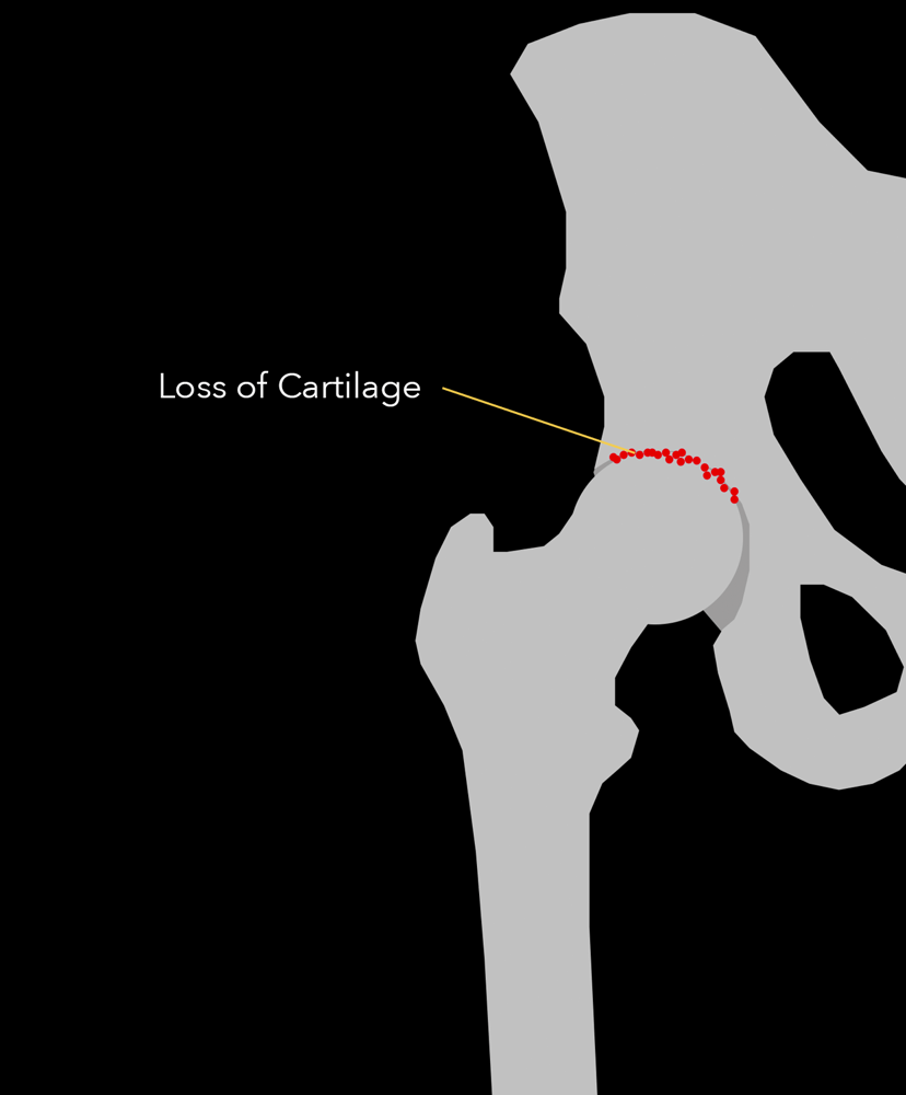 Joseph Maratt, MD Hip Arthritis