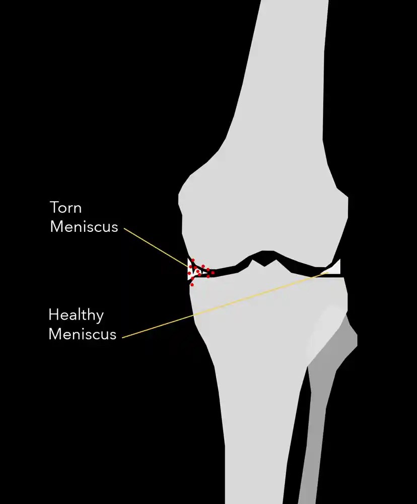 Meniscus Tear Joseph Maratt, MD