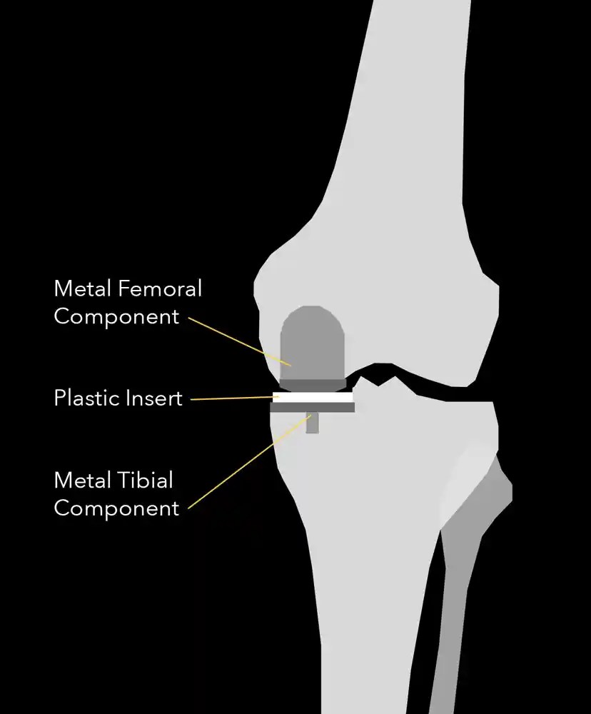 Knee Replacement Joseph Maratt, MD