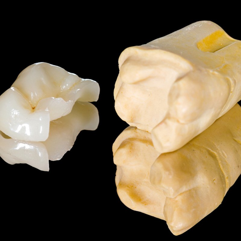 Dental Inlays & Onlays St. Louis, MO Perfect Smiles STL