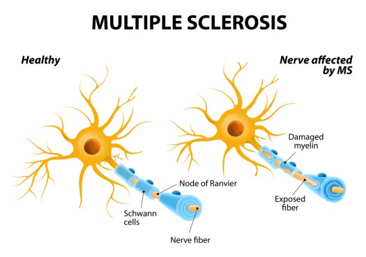 Multiple Sclerosis Strains