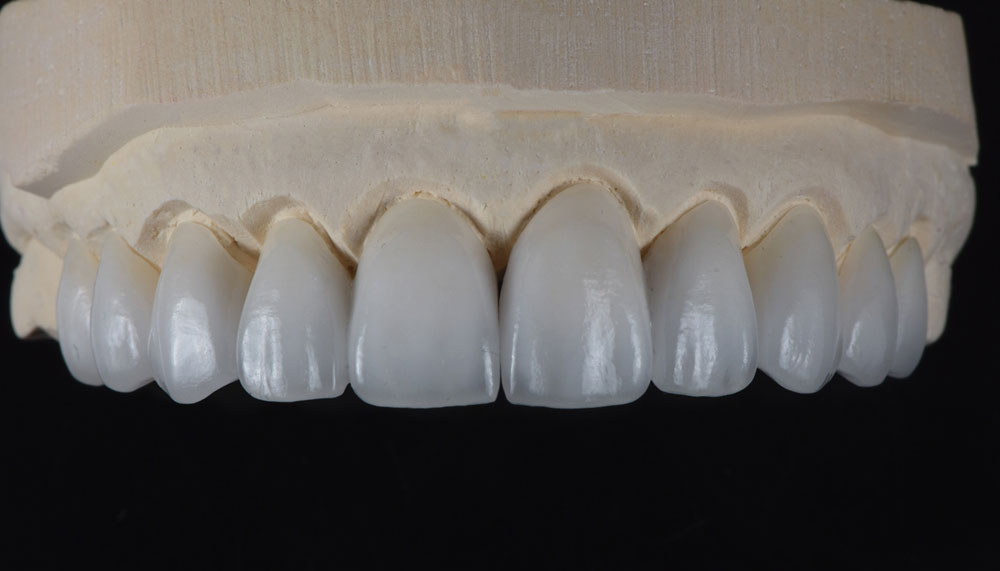 Dental Code For Emax Crown at Eleanor Garcia blog