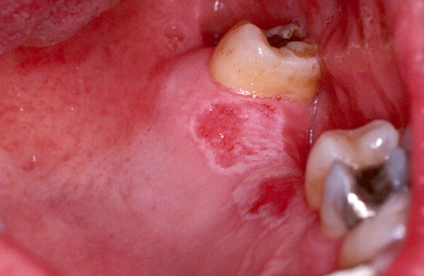 Burn Roof Of Mouth Blister Pictures Latest Rooftop Ideas