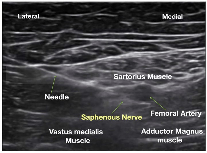 The Adductor Canal Nerve Block A Simple and Effective Approach for Knee Pain