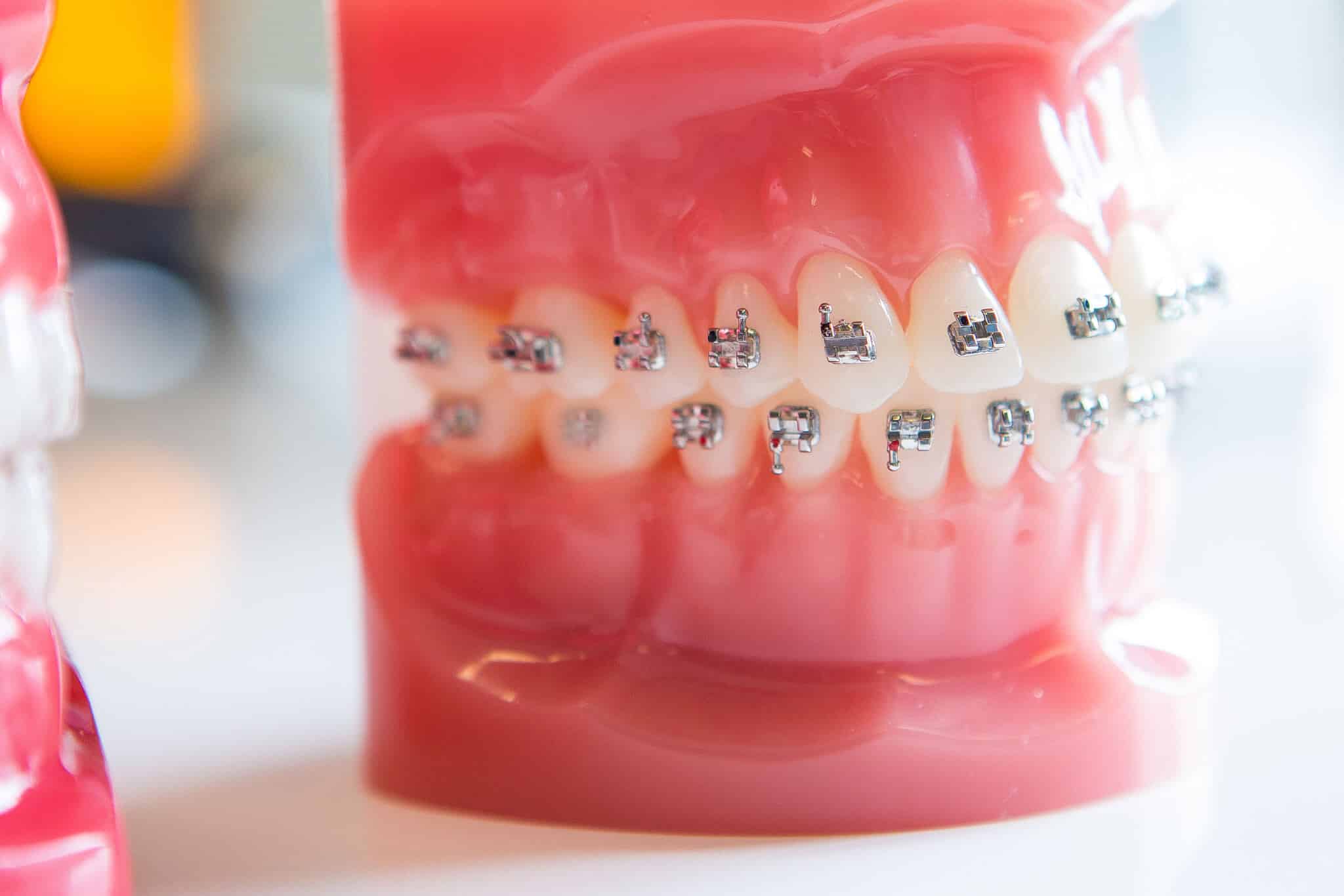 How do teeth move with braces? Freeman Orthodontics