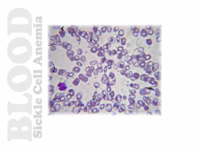 Cardiovascular System Sickle Cell
