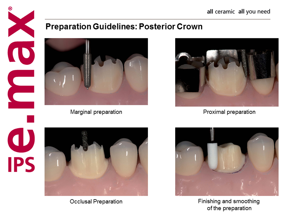 All Ceramic Crown Preparation