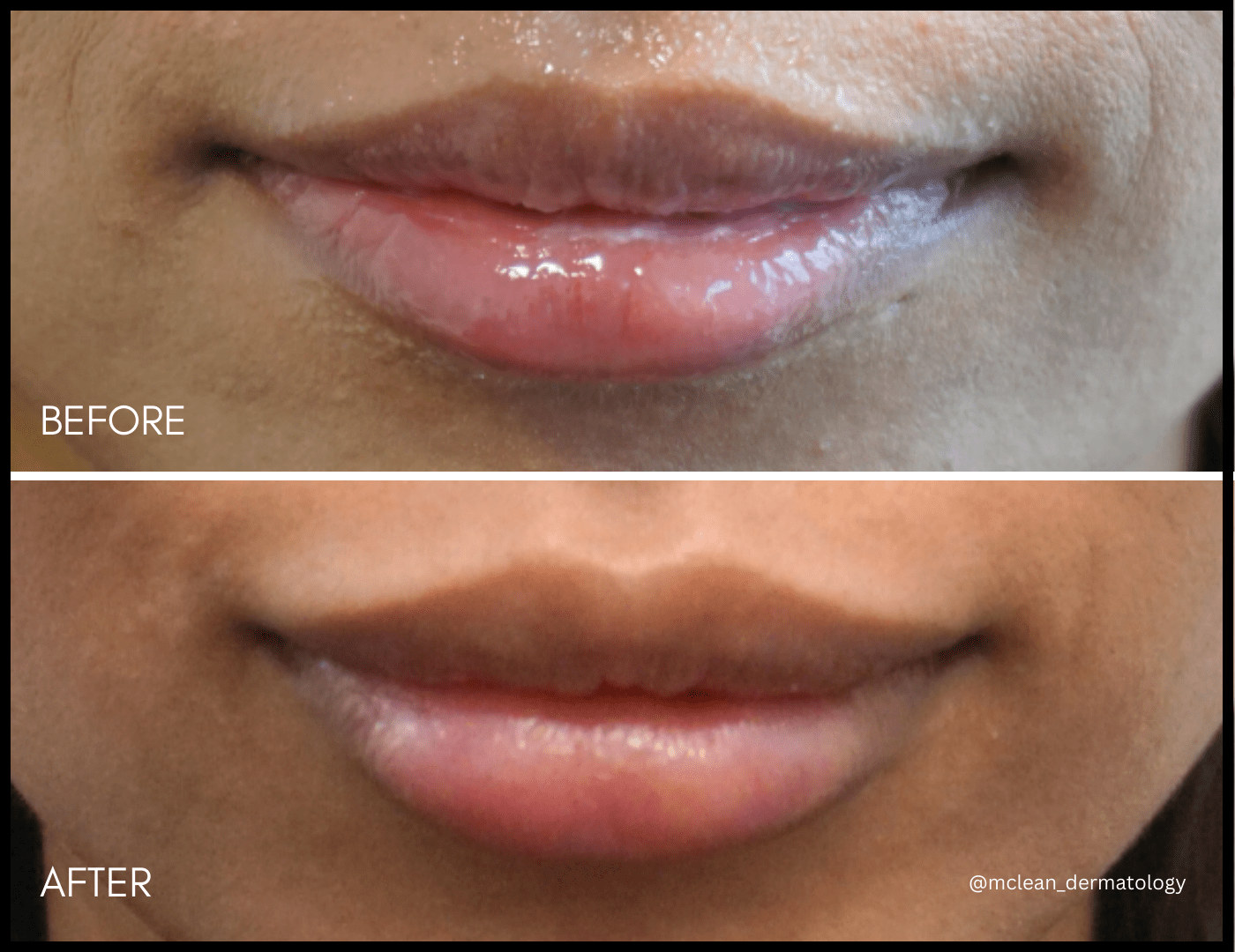 Dermal Fillers McLean & Potomac Dermatology