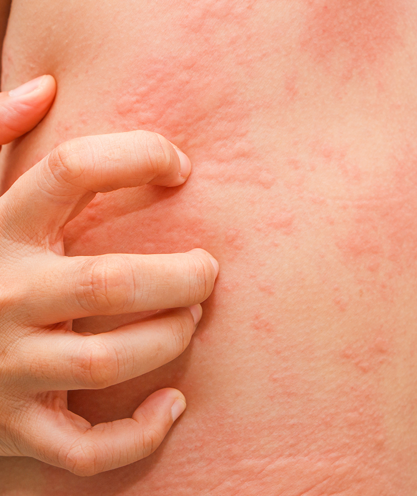 Hives Treatment McLean & Potomac Dermatology