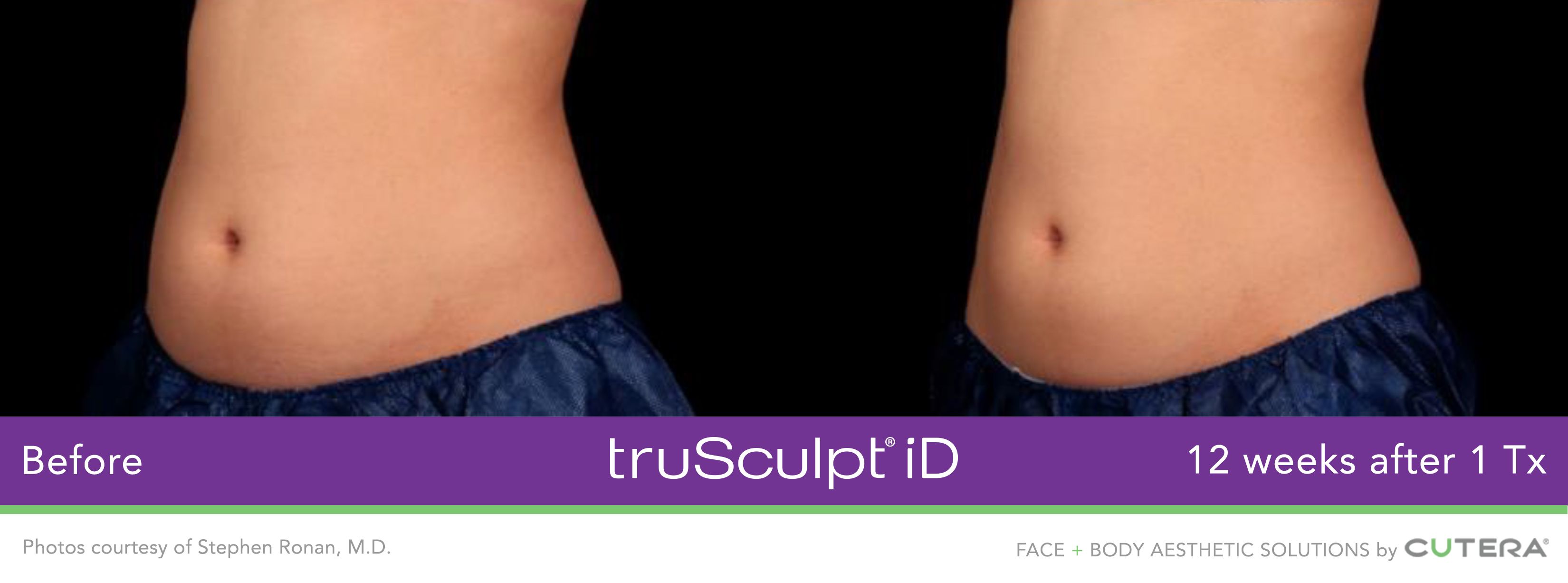 truSculpt ID THE CENTER for Advanced Dermatology