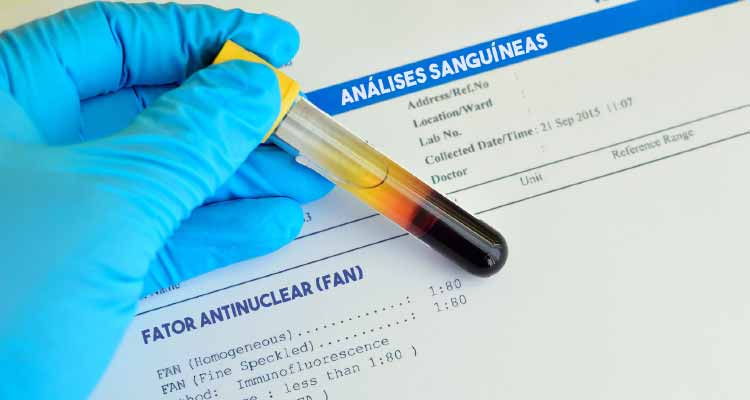Exame FAN (fator antinuclear) O Que Significa FAN Positivo MD.Saúde