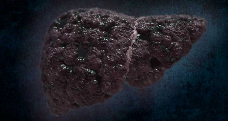 CIRROSE HEPÁTICA Sintomas, Causas e Tratamento » MD.Saúde