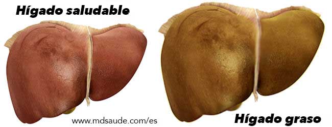 HÍGADO GRASO Esteatosis Hepática » MD.Saúde