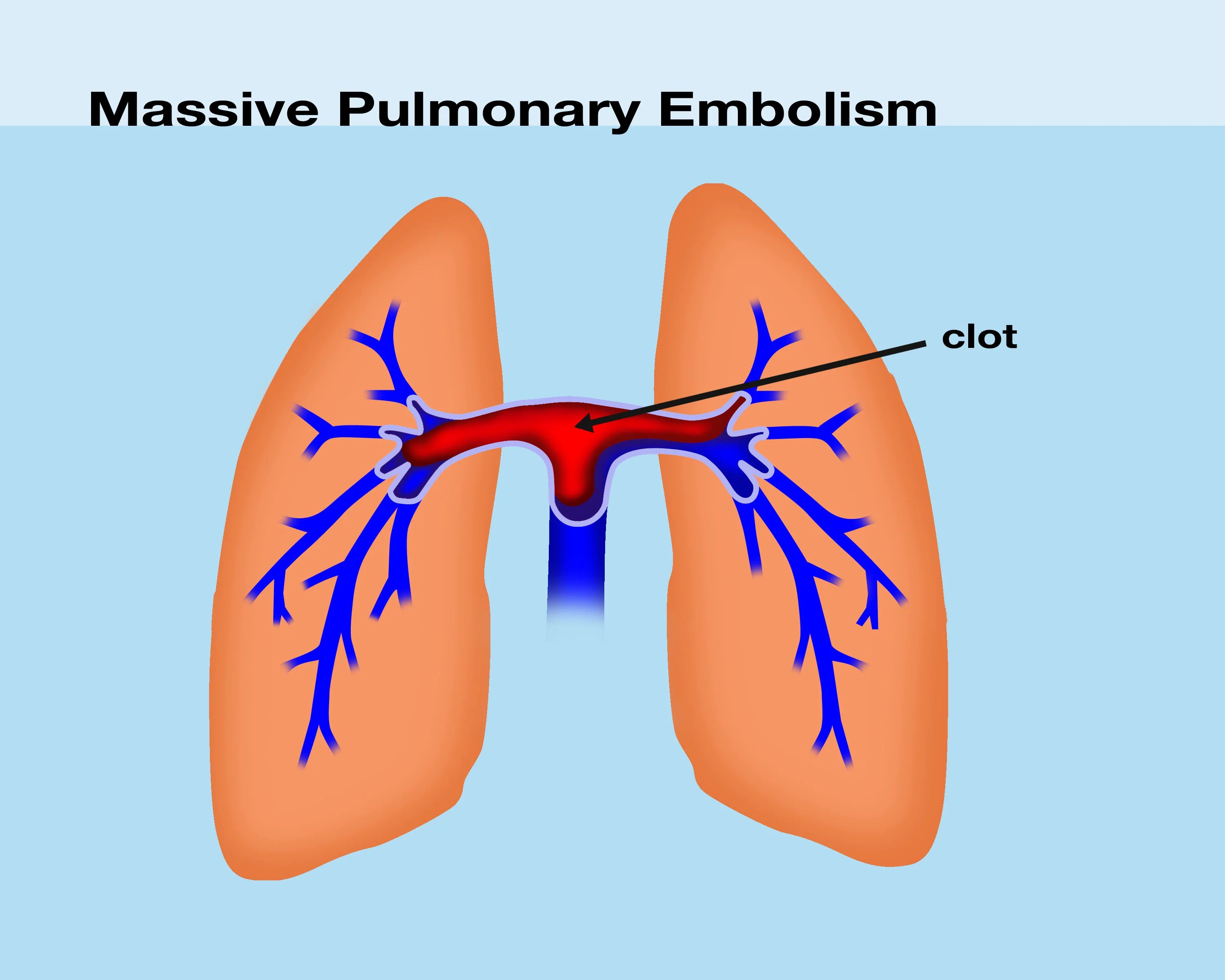What are the symptoms of a blood clot? UNC Hemophilia and Thrombosis