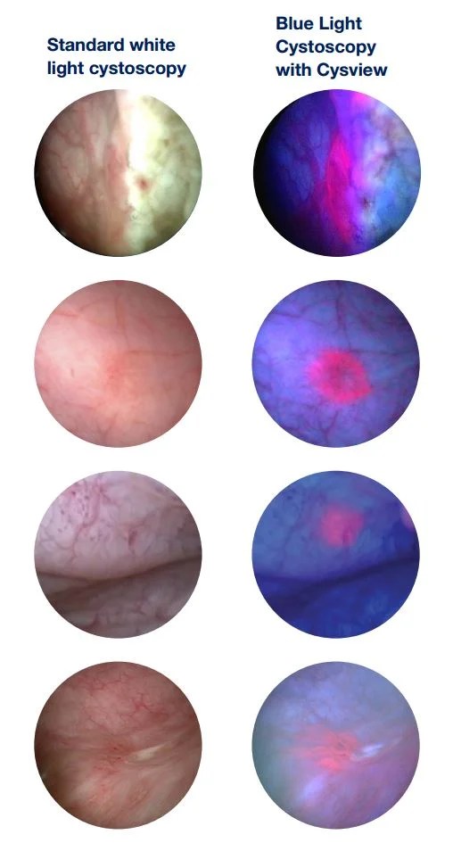 Blue Light Cystoscopy UNC Department of Urology