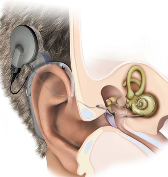 Cochlear Implant ENT Doctor in Forest Hills, Queens, NY Medex